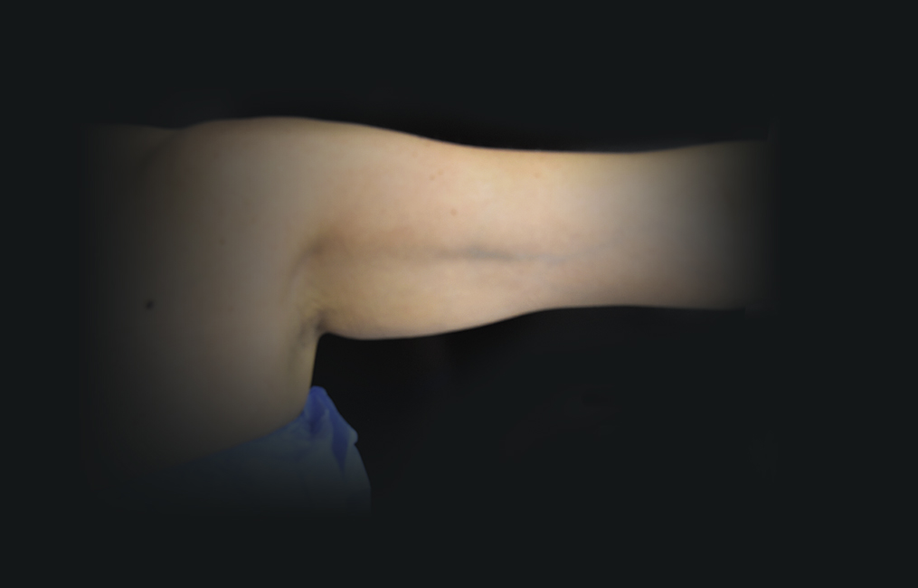 Vanquish treatments