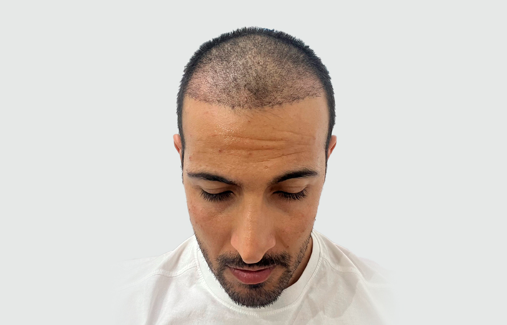 Microneedling Capilar