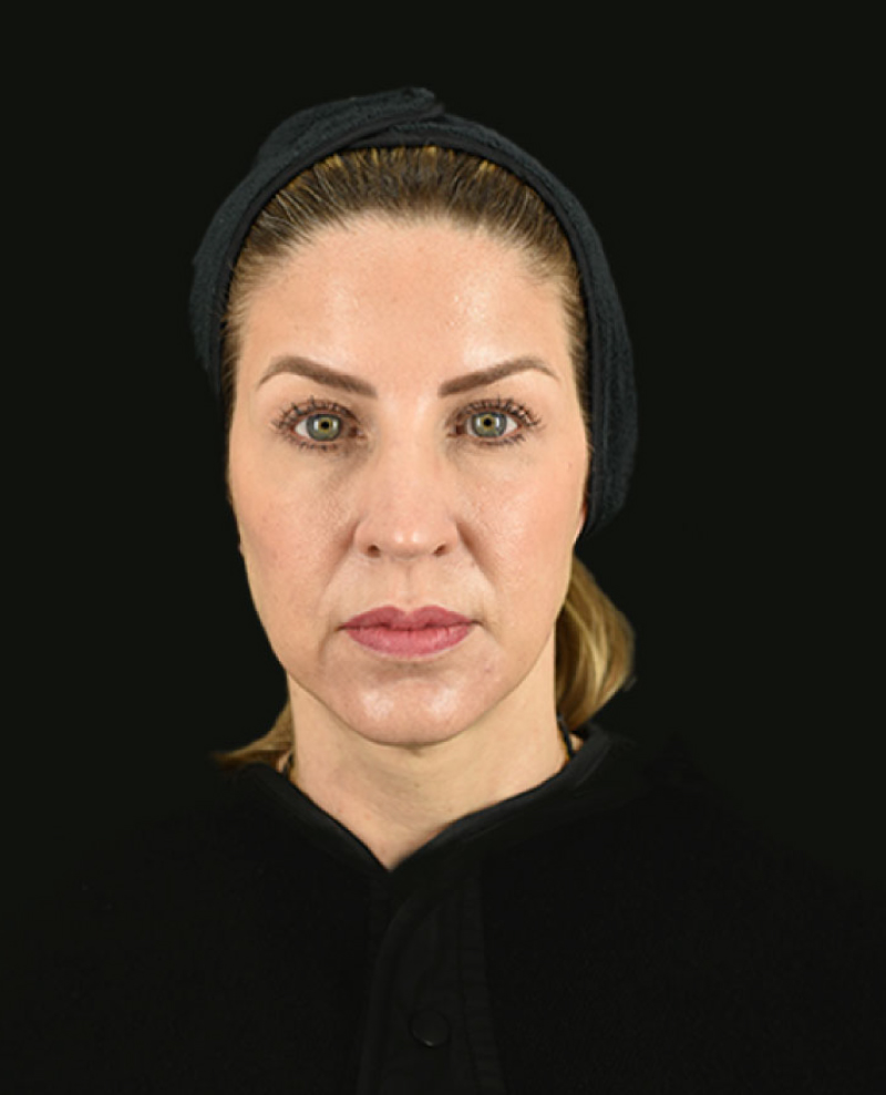 Juvéderm Voluma