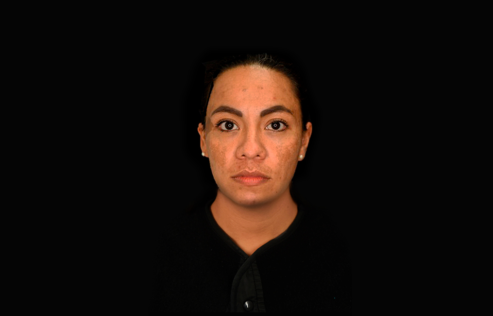 Tratamiento Retiro de melasma