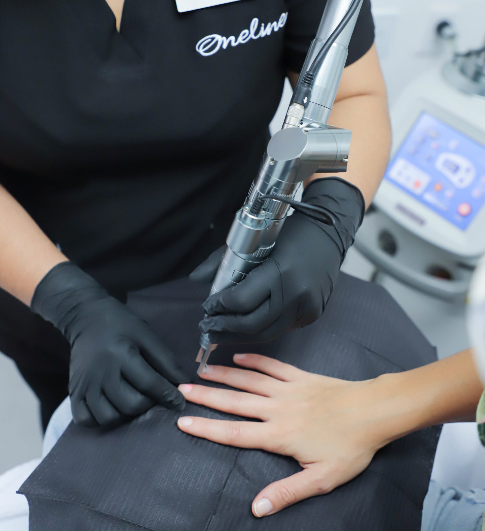 Tratamiento láser onicomicosis